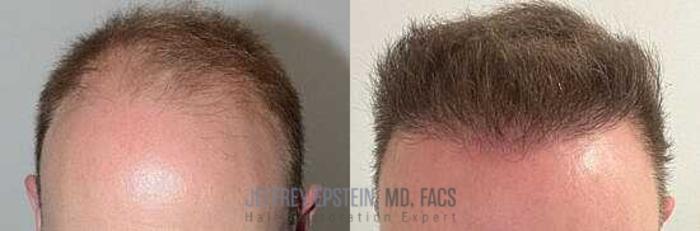 Before & After Hair Transplants For Men Case 3 View 3 View in Miami, FL