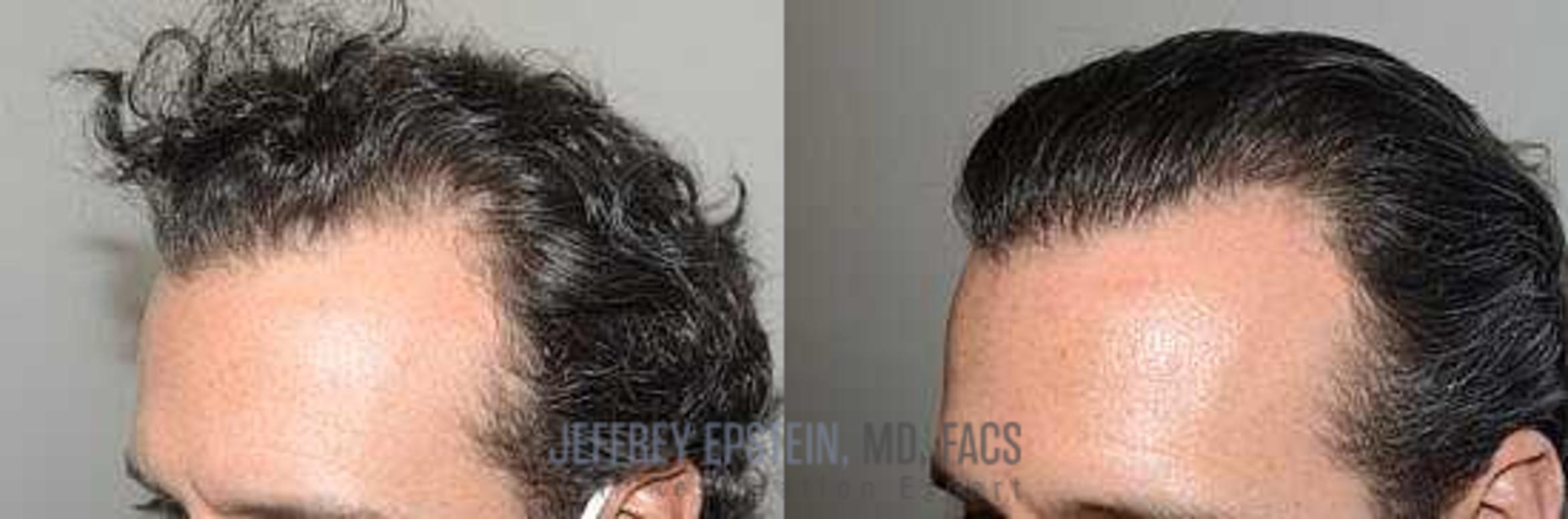 Before & After Hair Transplants For Men Case 32 View 1 View in Miami, FL