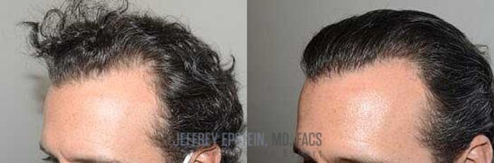 Before & After Hair Transplants For Men Case 32 View 1 View in Miami, FL