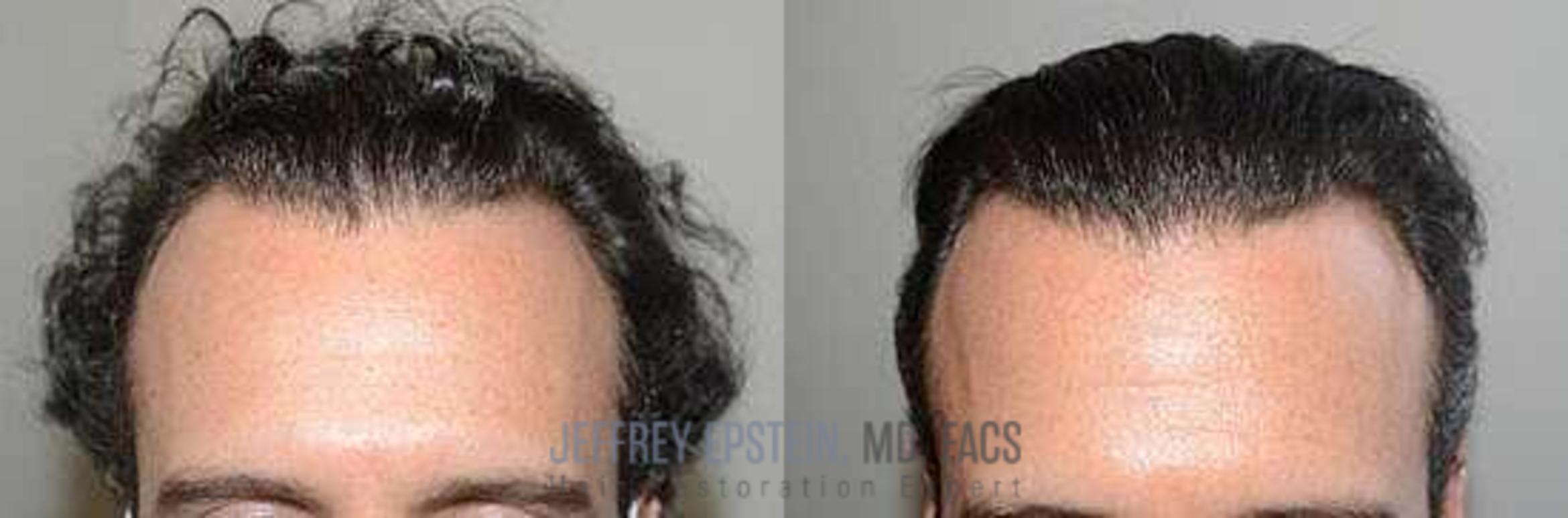 Before & After Hair Transplants For Men Case 32 View 2 View in Miami, FL