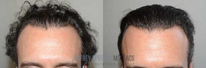 Before & After Hair Transplants For Men Case 32 View 2 View in Miami, FL