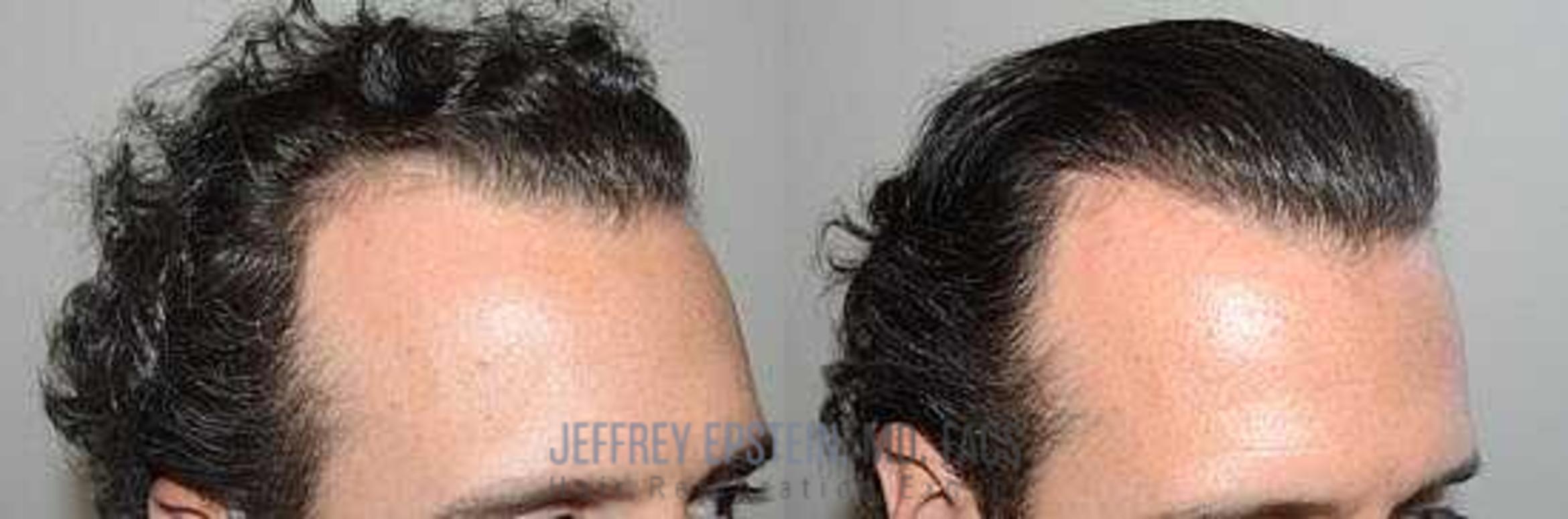 Before & After Hair Transplants For Men Case 32 View 3 View in Miami, FL