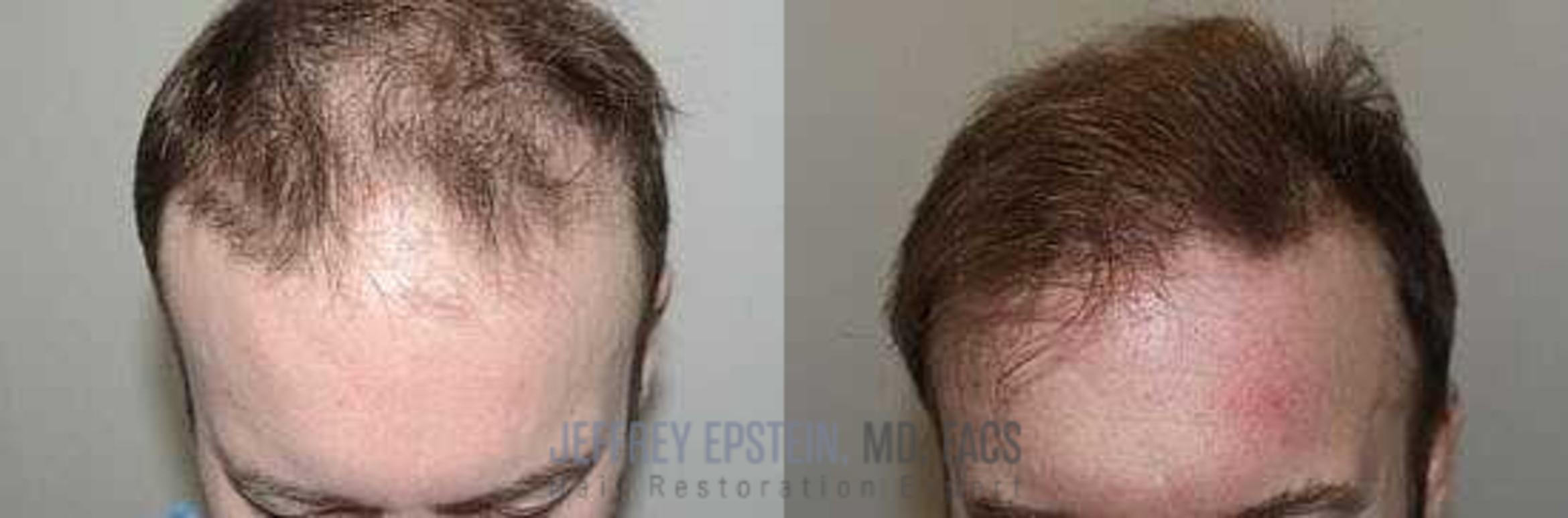 Before & After Hair Transplants For Men Case 33 View 1 View in Miami, FL