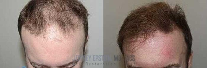 Before & After Hair Transplants For Men Case 33 View 1 View in Miami, FL