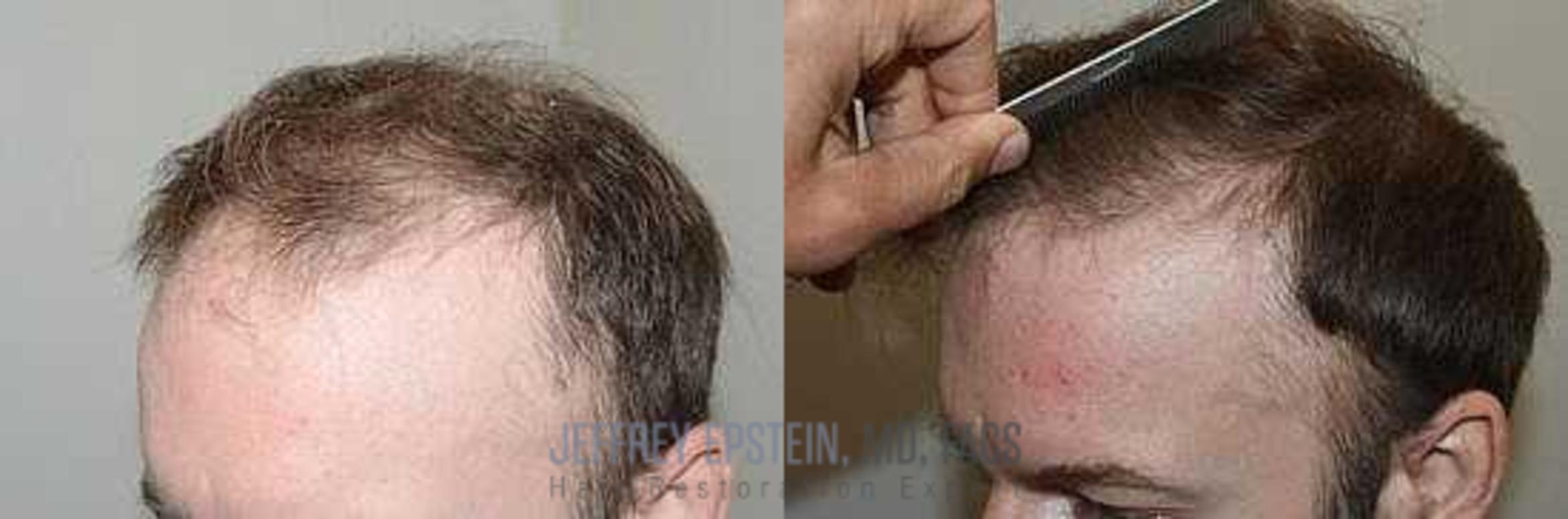 Before & After Hair Transplants For Men Case 33 View 2 View in Miami, FL