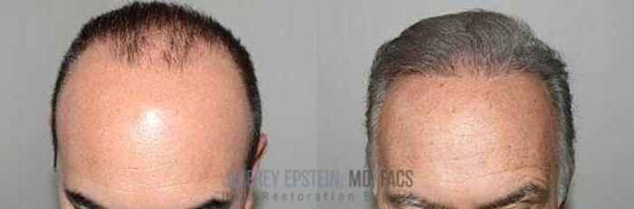 Before & After Hair Transplants For Men Case 34 View 1 View in Miami, FL