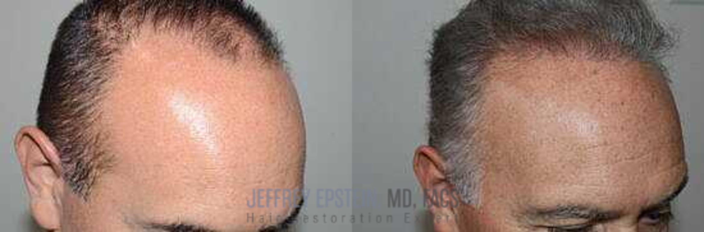 Before & After Hair Transplants For Men Case 34 View 2 View in Miami, FL