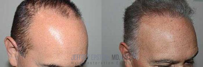 Before & After Hair Transplants For Men Case 34 View 2 View in Miami, FL