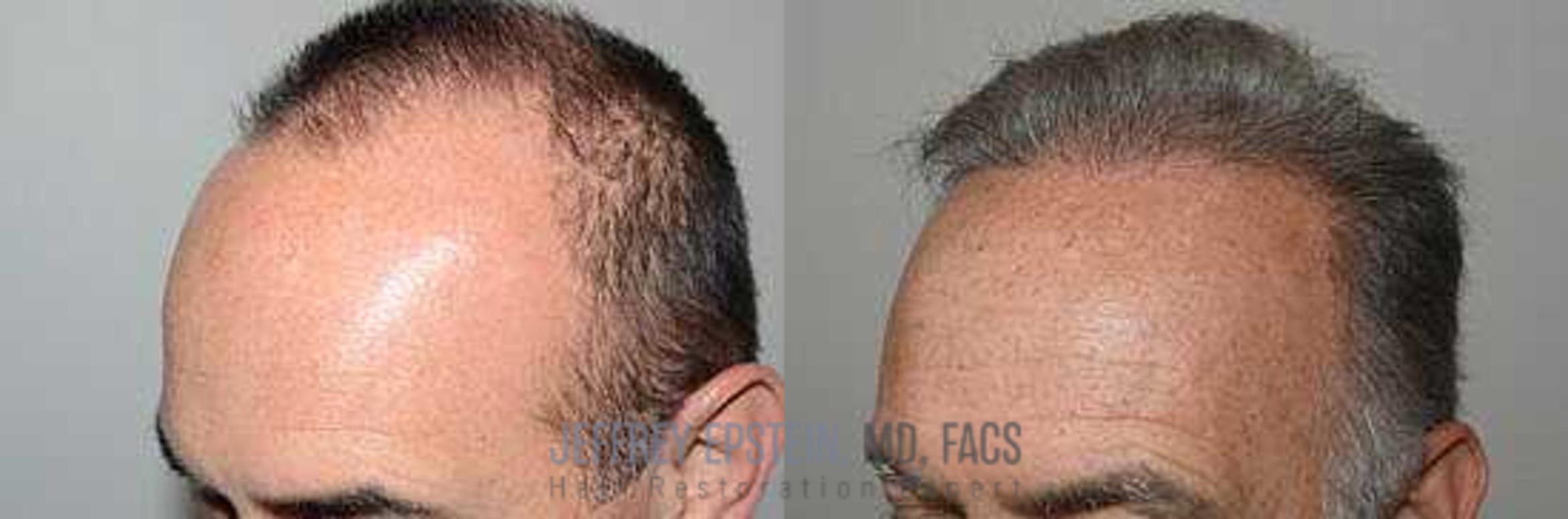 Before & After Hair Transplants For Men Case 34 View 3 View in Miami, FL