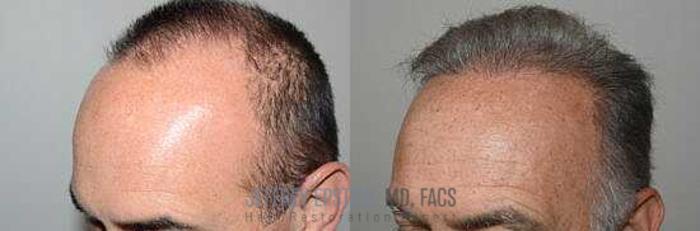 Before & After Hair Transplants For Men Case 34 View 3 View in Miami, FL