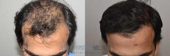 Before & After Hair Transplants For Men Case 345 View 1 View in Miami, FL