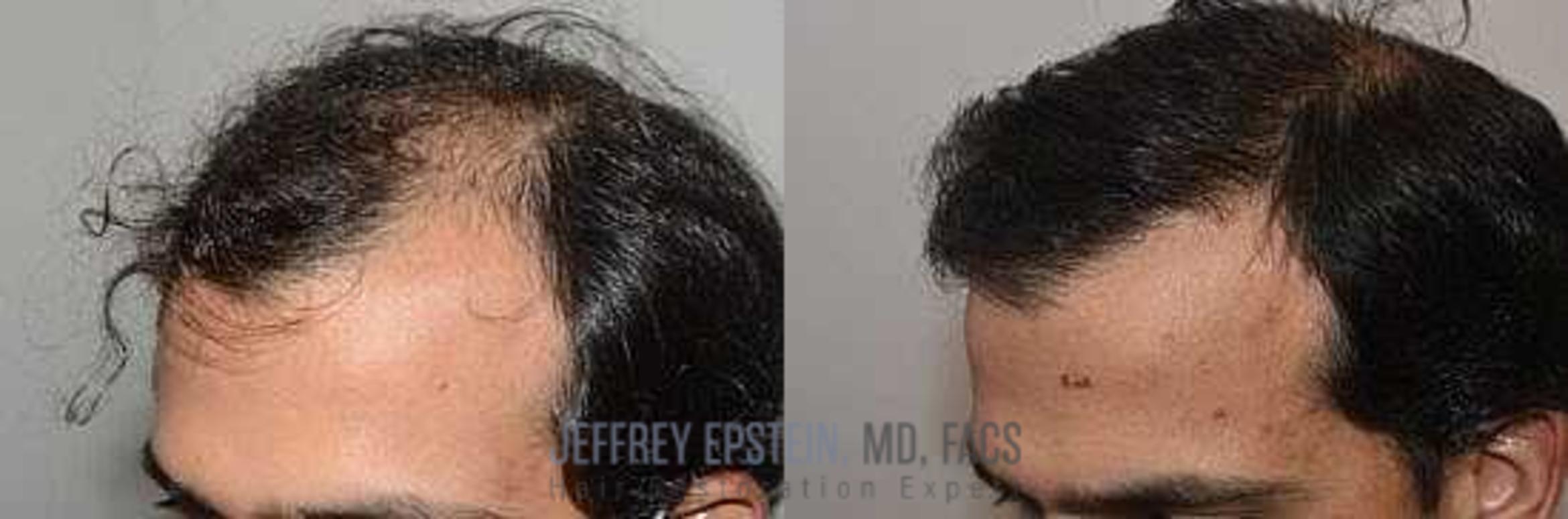Before & After Hair Transplants For Men Case 345 View 2 View in Miami, FL