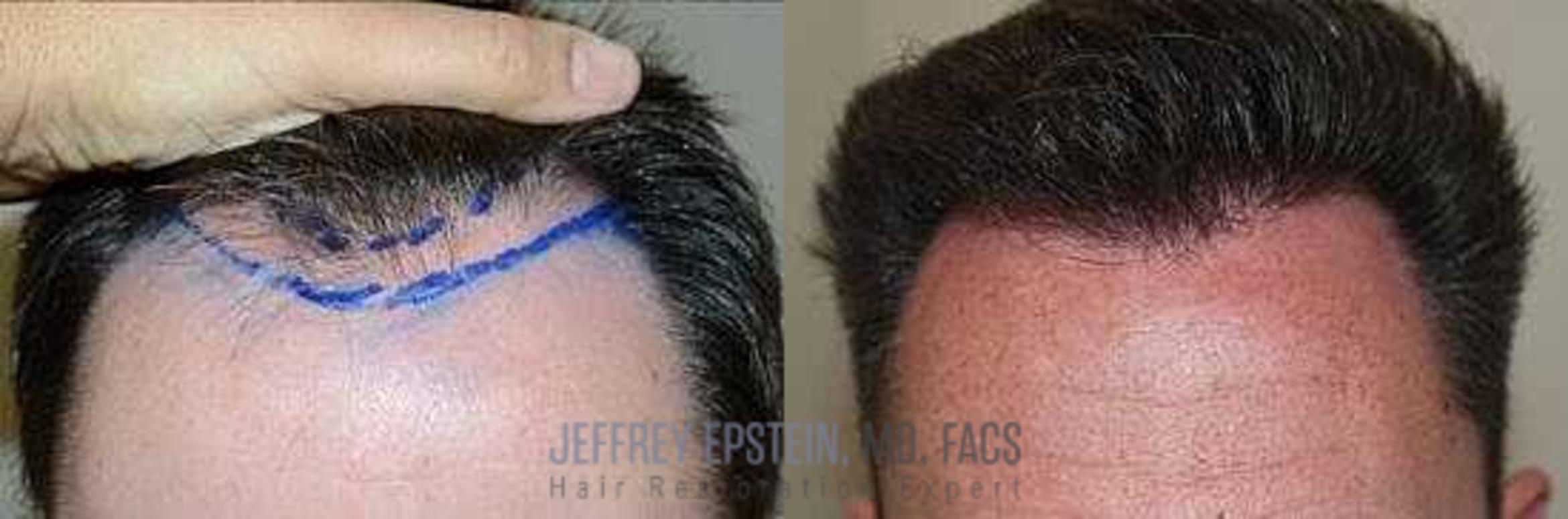 Before & After Hair Transplants For Men Case 347 View 1 View in Miami, FL