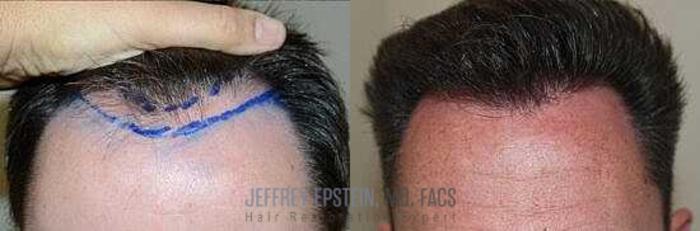 Before & After Hair Transplants For Men Case 347 View 1 View in Miami, FL