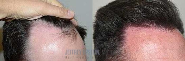 Before & After Hair Transplants For Men Case 347 View 2 View in Miami, FL
