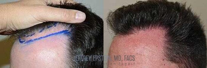 Before & After Hair Transplants For Men Case 347 View 3 View in Miami, FL