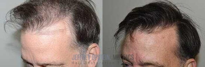 Before & After Hair Transplants For Men Case 348 View 2 View in Miami, FL