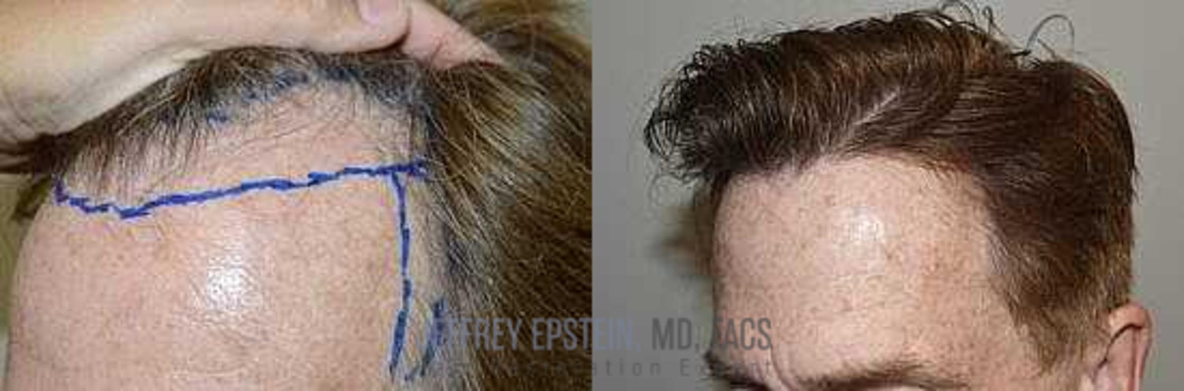 Before & After Hair Transplants For Men Case 349 View 1 View in Miami, FL