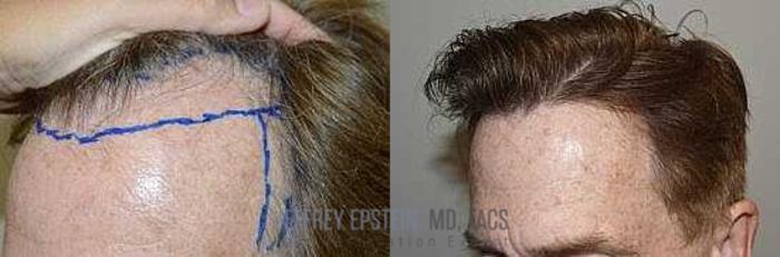 Before & After Hair Transplants For Men Case 349 View 1 View in Miami, FL