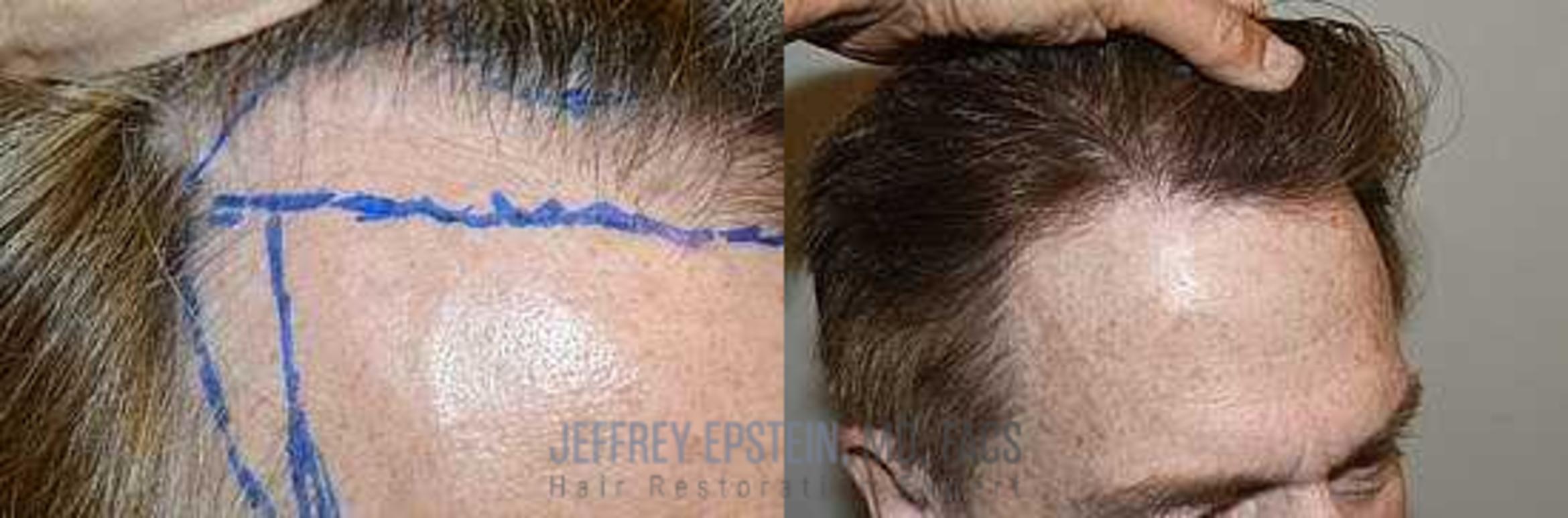 Before & After Hair Transplants For Men Case 349 View 2 View in Miami, FL