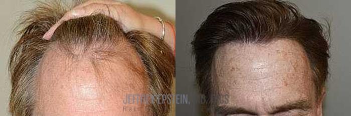 Before & After Hair Transplants For Men Case 349 View 3 View in Miami, FL