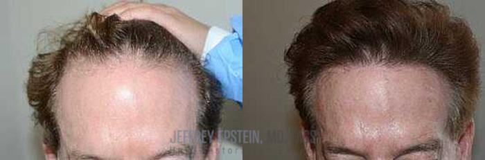 Before & After Hair Transplants For Men Case 35 View 1 View in Miami, FL