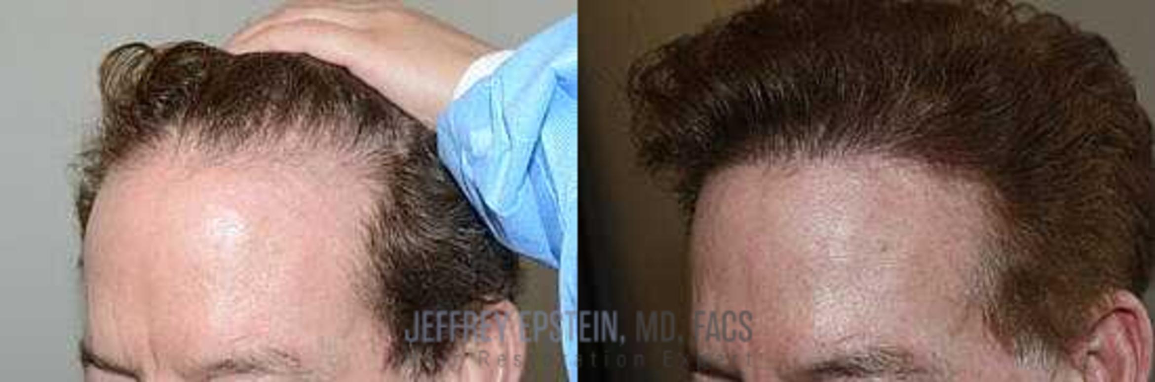 Before & After Hair Transplants For Men Case 35 View 2 View in Miami, FL