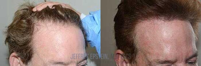 Before & After Hair Transplants For Men Case 35 View 3 View in Miami, FL