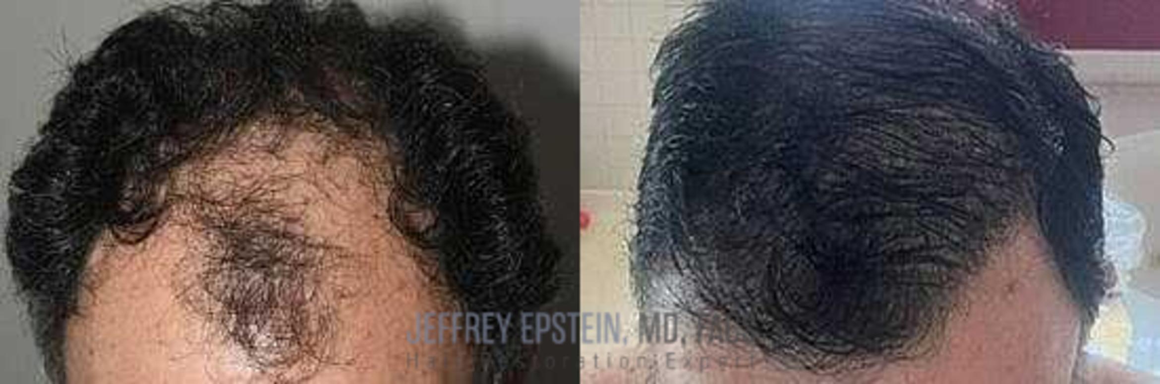 Before & After Hair Transplants For Men Case 350 View 1 View in Miami, FL