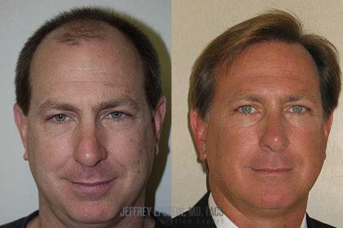 Before & After Hair Transplants For Men Case 351 View 1 View in Miami, FL