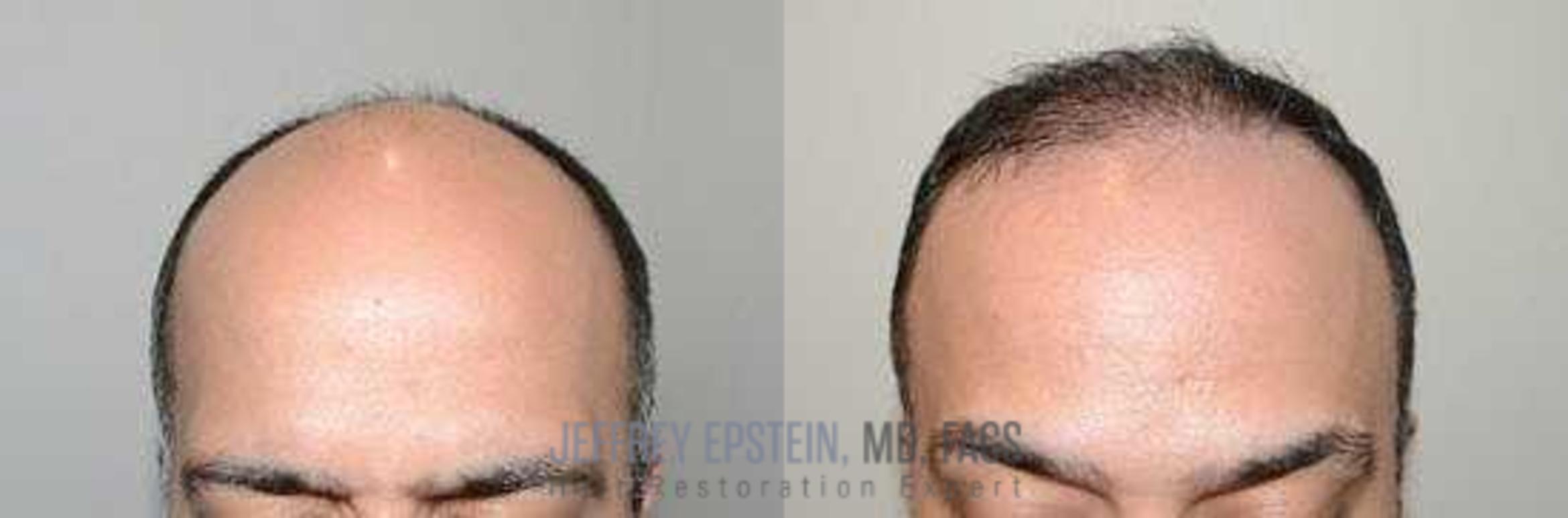 Before & After Hair Transplants For Men Case 352 View 1 View in Miami, FL