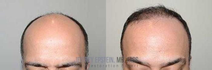 Before & After Hair Transplants For Men Case 352 View 1 View in Miami, FL