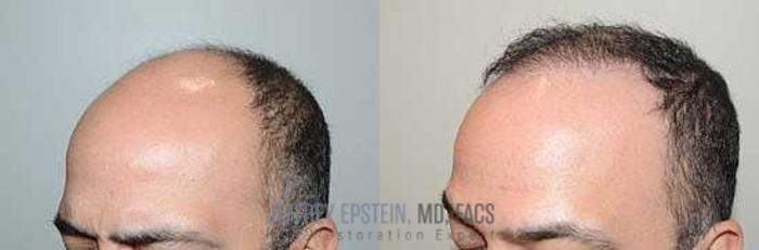 Before & After Hair Transplants For Men Case 352 View 2 View in Miami, FL