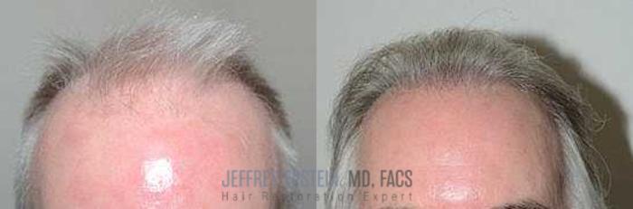 Before & After Body Hair Transplant (BHT) Case 353 View 1 View in Miami, FL