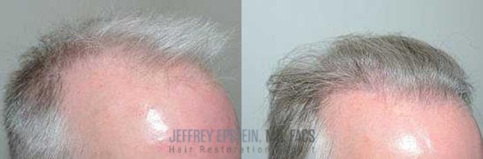 Before & After Hair Transplants For Men Case 353 View 2 View in Miami, FL