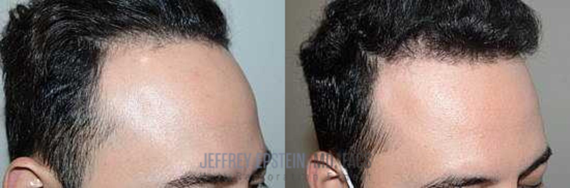 Before & After Hair Transplants For Men Case 354 View 1 View in Miami, FL
