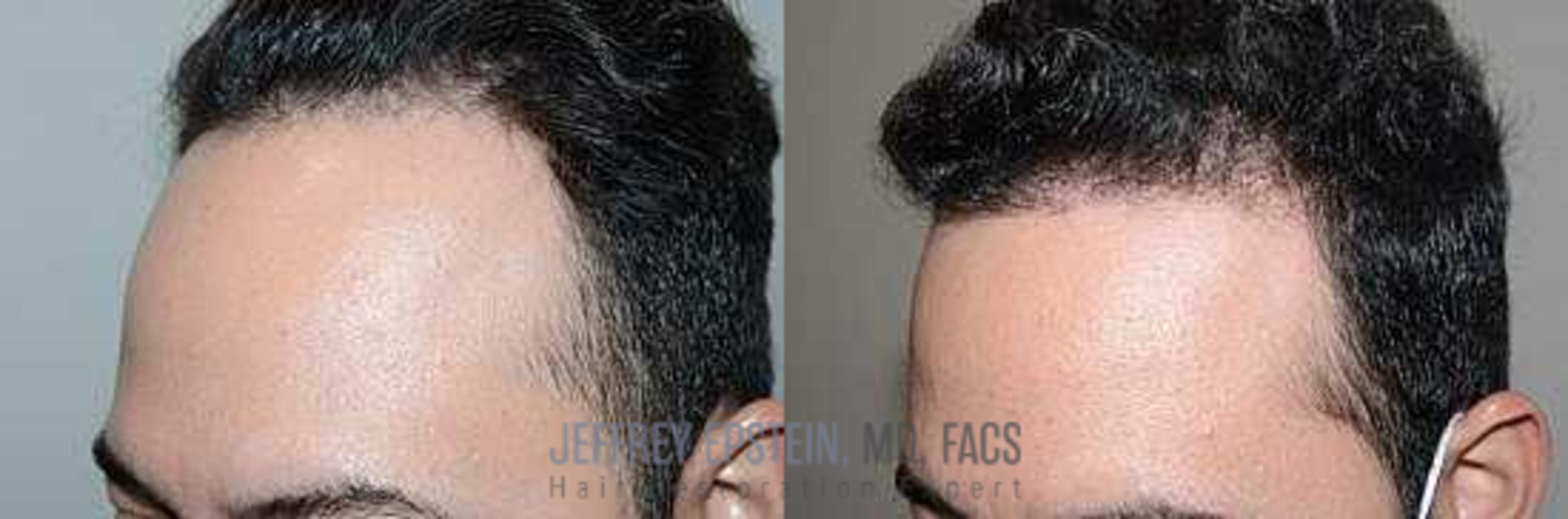 Before & After Hair Transplants For Men Case 354 View 2 View in Miami, FL