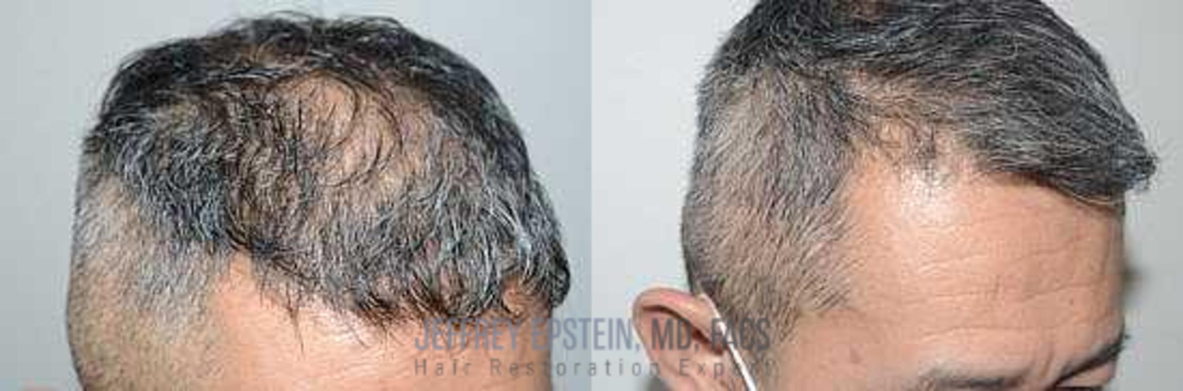 Before & After Hair Transplants For Men Case 358 View 1 View in Miami, FL