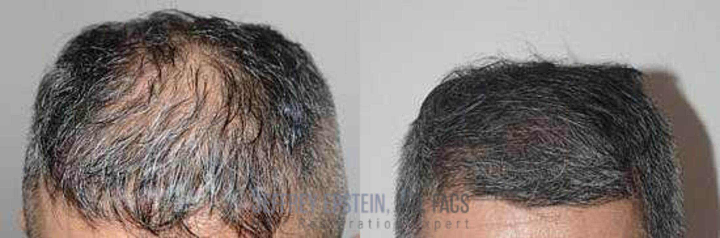Before & After Hair Transplants For Men Case 358 View 2 View in Miami, FL