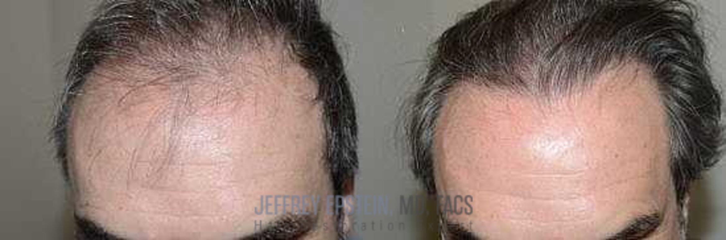 Before & After Hair Transplants For Men Case 359 View 1 View in Miami, FL