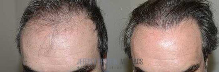 Before & After Hair Transplants For Men Case 359 View 1 View in Miami, FL