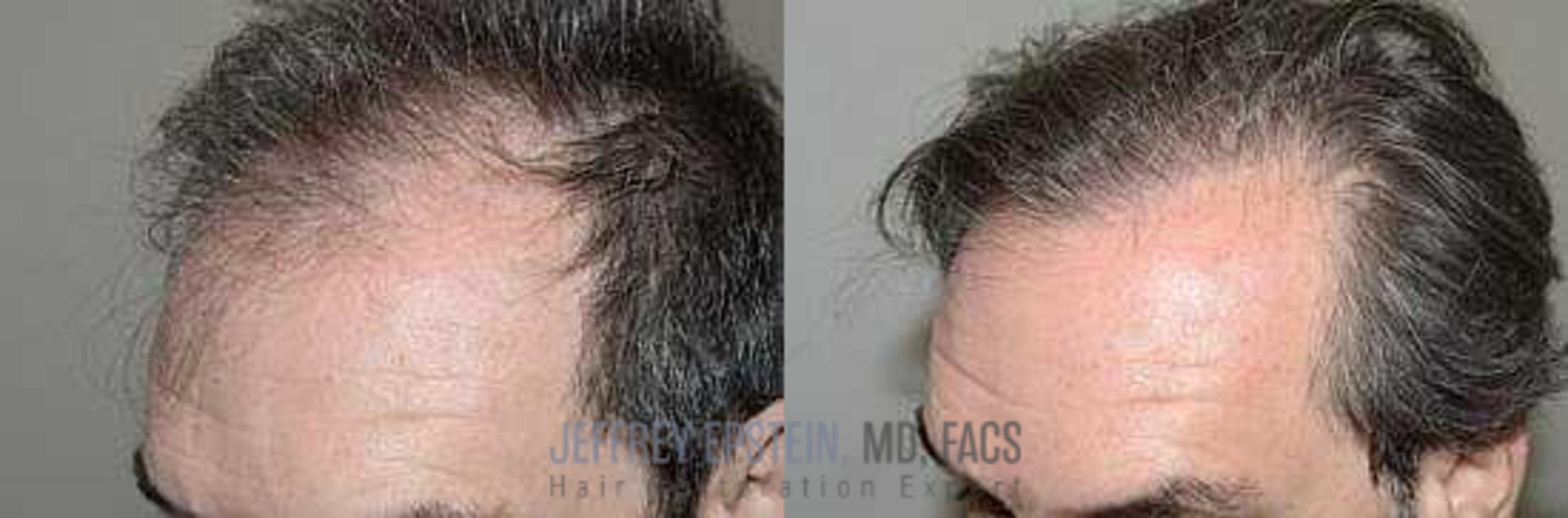 Before & After Hair Transplants For Men Case 359 View 2 View in Miami, FL