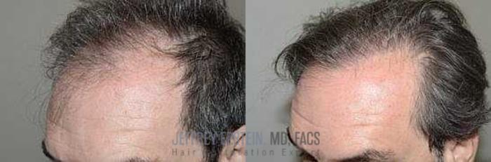 Before & After Hair Transplants For Men Case 359 View 2 View in Miami, FL