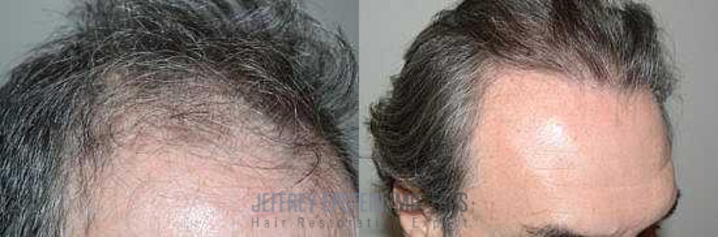 Before & After Hair Transplants For Men Case 359 View 3 View in Miami, FL