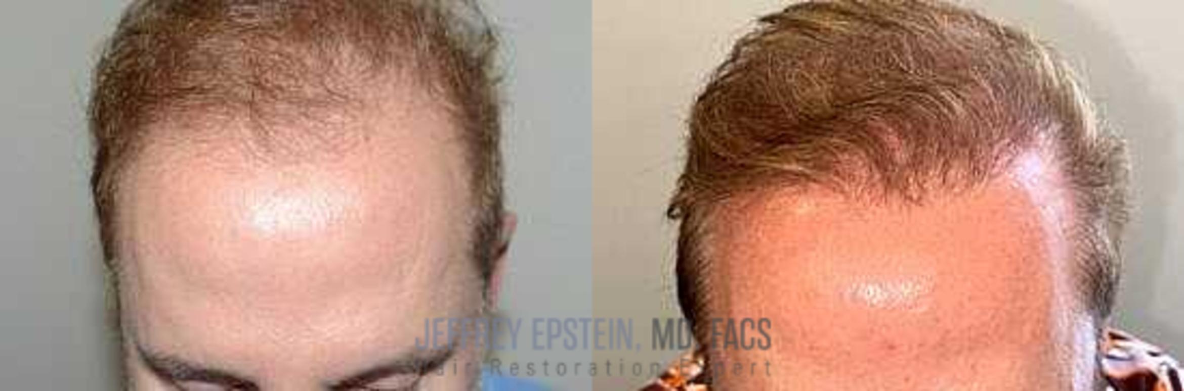Before & After Hair Transplants For Men Case 360 View 1 View in Miami, FL