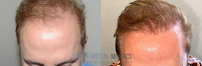 Before & After Hair Transplants For Men Case 360 View 1 View in Miami, FL