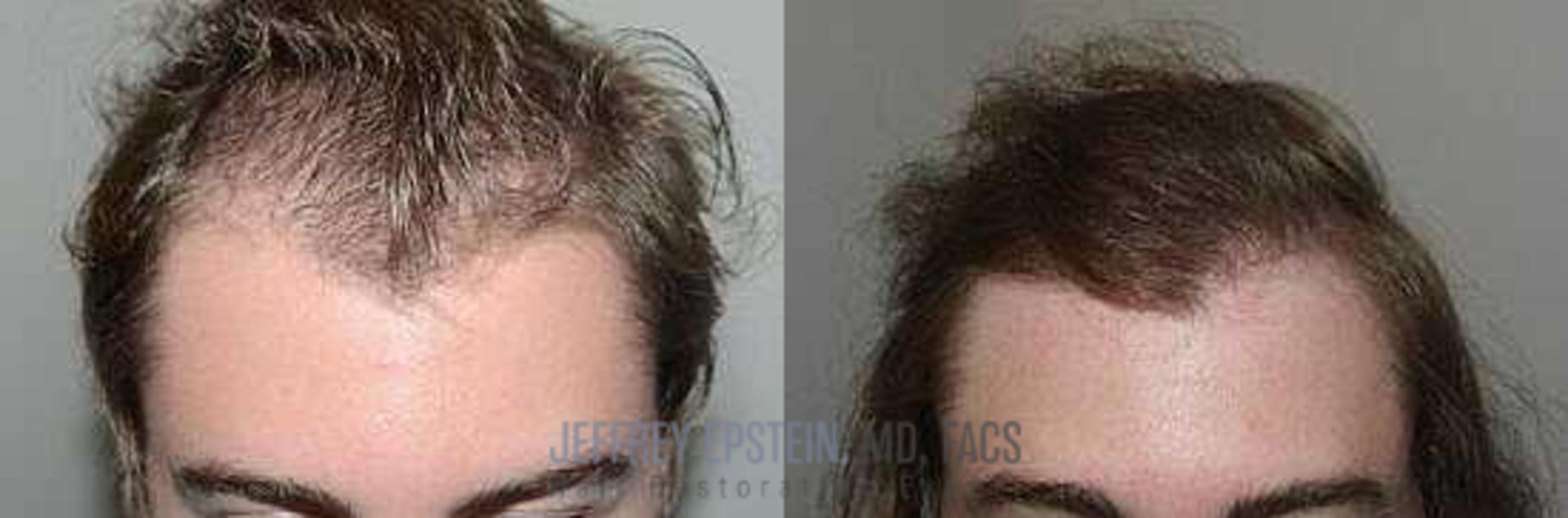 Before & After Hair Transplants For Men Case 361 View 1 View in Miami, FL