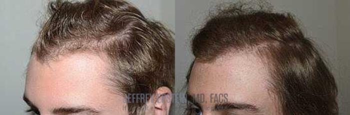 Before & After Hair Transplants For Men Case 361 View 2 View in Miami, FL
