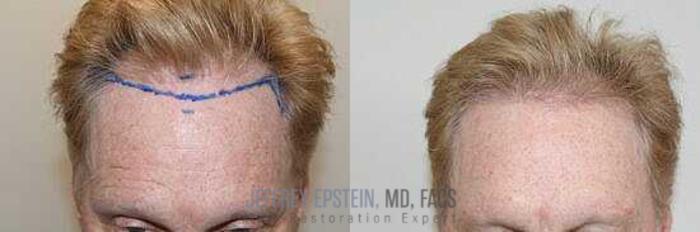 Before & After Hair Transplants For Men Case 37 View 1 View in Miami, FL