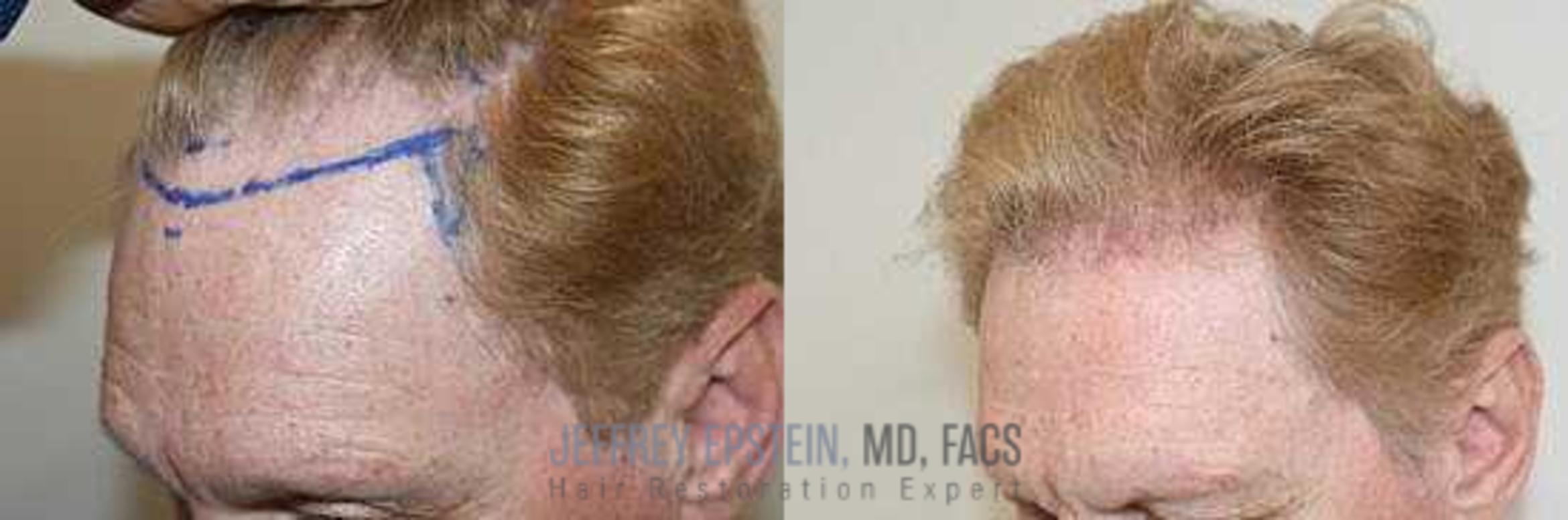 Before & After Hair Transplants For Men Case 37 View 2 View in Miami, FL